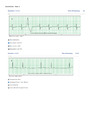 Relias Dysrhythmia Basic Test 35 Questions and Answers 2023 (Basic A Dysrhythmia)